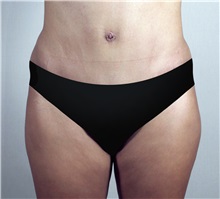 Tummy Tuck After Photo by Paul Parker, MD; Paramus, NJ - Case 35115