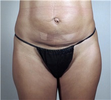 Tummy Tuck Before Photo by Paul Parker, MD; Paramus, NJ - Case 35115