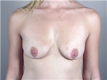 Breast Augmentation Before Photo by Paul Parker, MD; Paramus, NJ - Case 35116