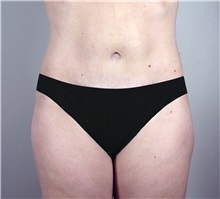 Tummy Tuck After Photo by Paul Parker, MD; Paramus, NJ - Case 35119