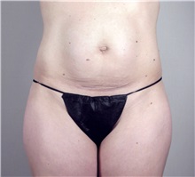 How Long Does a Tummy Tuck Last?  Parker Center for Plastic Surgery