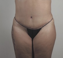 Tummy Tuck After Photo by Paul Parker, MD; Paramus, NJ - Case 49980 Tummy Tuck After Photo by Paul Parker, MD; Paramus, NJ - Case 49980