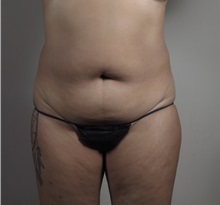 Tummy Tuck Before Photo by Paul Parker, MD; Paramus, NJ - Case 49980 Tummy Tuck Before Photo by Paul Parker, MD; Paramus, NJ - Case 49980