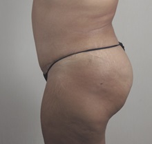 Tummy Tuck After Photo by Paul Parker, MD; Paramus, NJ - Case 49980
