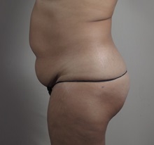 Tummy Tuck Before Photo by Paul Parker, MD; Paramus, NJ - Case 49980