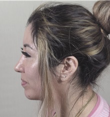 Rhinoplasty After Photo by Paul Parker, MD; Paramus, NJ - Case 49985