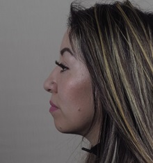 Rhinoplasty Before Photo by Paul Parker, MD; Paramus, NJ - Case 49985