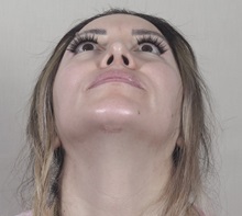 Rhinoplasty After Photo by Paul Parker, MD; Paramus, NJ - Case 49985