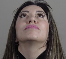 Rhinoplasty Before Photo by Paul Parker, MD; Paramus, NJ - Case 49985