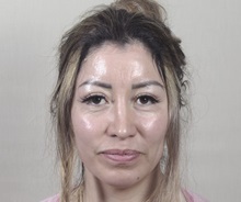 Rhinoplasty After Photo by Paul Parker, MD; Paramus, NJ - Case 49985
