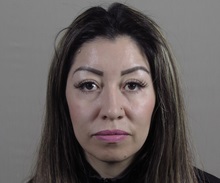 Rhinoplasty Before Photo by Paul Parker, MD; Paramus, NJ - Case 49985