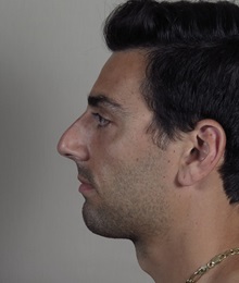 Rhinoplasty Before Photo by Paul Parker, MD; Paramus, NJ - Case 49984