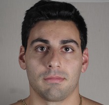 Rhinoplasty Before Photo by Paul Parker, MD; Paramus, NJ - Case 49984