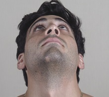 Rhinoplasty After Photo by Paul Parker, MD; Paramus, NJ - Case 49984