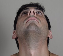 Rhinoplasty Before Photo by Paul Parker, MD; Paramus, NJ - Case 49984