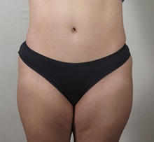 Tummy Tuck After Photo by Paul Parker, MD; Paramus, NJ - Case 49981 Tummy Tuck After Photo by Paul Parker, MD; Paramus, NJ - Case 49981