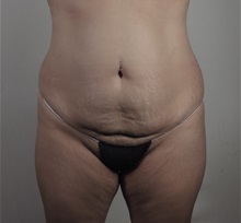 Tummy Tuck Before Photo by Paul Parker, MD; Paramus, NJ - Case 49981 Tummy Tuck Before Photo by Paul Parker, MD; Paramus, NJ - Case 49981