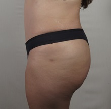 Tummy Tuck After Photo by Paul Parker, MD; Paramus, NJ - Case 49981