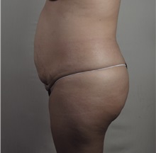 Tummy Tuck Before Photo by Paul Parker, MD; Paramus, NJ - Case 49981