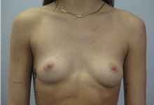 Breast Augmentation Before Photo by Paul Parker, MD; Paramus, NJ - Case 49987 Breast Augmentation Before Photo by Paul Parker, MD; Paramus, NJ - Case 49987