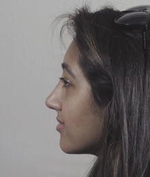 Rhinoplasty After Photo by Paul Parker, MD; Paramus, NJ - Case 49983