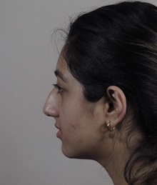 Rhinoplasty Before Photo by Paul Parker, MD; Paramus, NJ - Case 49983