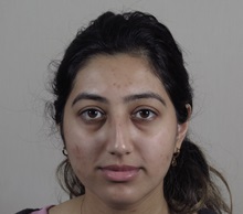 Rhinoplasty Before Photo by Paul Parker, MD; Paramus, NJ - Case 49983