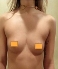 Breast Augmentation Before Photo by Joseph Pober, MD, FACS; New York,  - Case 37203