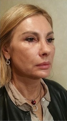 Facelift After Photo by Joseph Pober, MD, FACS; New York,  - Case 37206