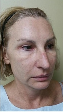 Facelift Before Photo by Joseph Pober, MD, FACS; New York,  - Case 37206
