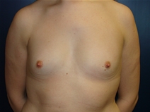 Breast Augmentation Before Photo by J Michael Conkright, MD; ,  - Case 10301