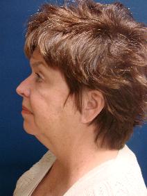 Liposuction After Photo by J Michael Conkright, MD; ,  - Case 10305