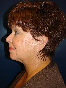Liposuction Before Photo by J Michael Conkright, MD; ,  - Case 10305