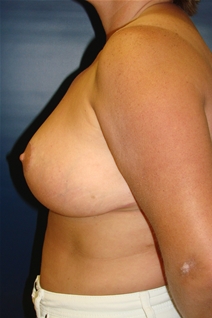 Breast Reduction After Photo by J Michael Conkright, MD; ,  - Case 20641