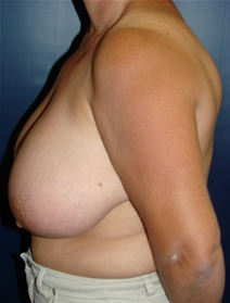 Breast Reduction Before Photo by J Michael Conkright, MD; ,  - Case 20641