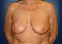 Breast Lift Before Photo by J Michael Conkright, MD; ,  - Case 20643