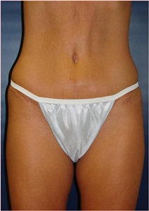 Tummy Tuck After Photo by J Michael Conkright, MD; ,  - Case 20644