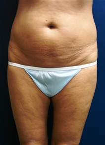 Tummy Tuck Before Photo by J Michael Conkright, MD; ,  - Case 20644