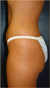 Tummy Tuck After Photo by J Michael Conkright, MD; ,  - Case 20644