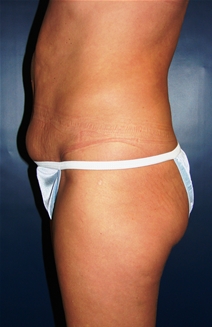 Tummy Tuck Before Photo by J Michael Conkright, MD; ,  - Case 20644