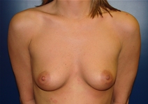 Breast Augmentation Before Photo by J Michael Conkright, MD; ,  - Case 20645