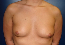 Breast Augmentation Before Photo by J Michael Conkright, MD; ,  - Case 20646
