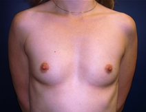 Breast Augmentation Before Photo by J Michael Conkright, MD; ,  - Case 20647