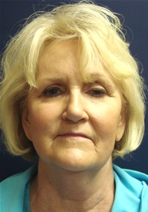 Facelift Before Photo by J Michael Conkright, MD; ,  - Case 20648