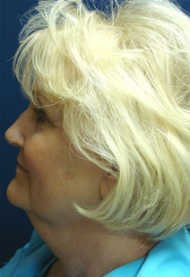 Facelift Before Photo by J Michael Conkright, MD; ,  - Case 20648