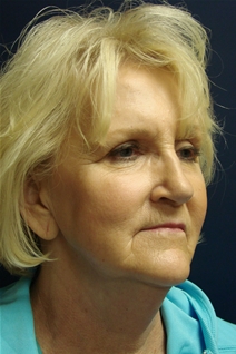 Facelift Before Photo by J Michael Conkright, MD; ,  - Case 20648