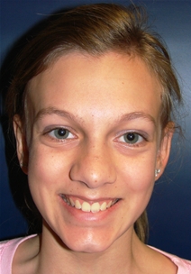 Ear Surgery After Photo by J Michael Conkright, MD; ,  - Case 20649