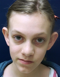 Ear Surgery Before Photo by J Michael Conkright, MD; ,  - Case 20649