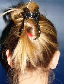 Ear Surgery After Photo by J Michael Conkright, MD; ,  - Case 20649