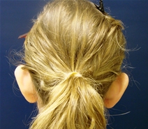 Ear Surgery Before Photo by J Michael Conkright, MD; ,  - Case 20649